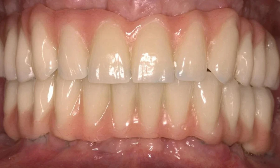 Bocca di un paziente prima dell'operazione con nuova dentatura
