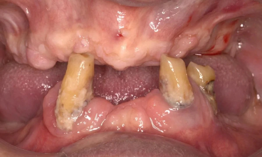 Bocca di un paziente prima dell'operazione con poca dentatura