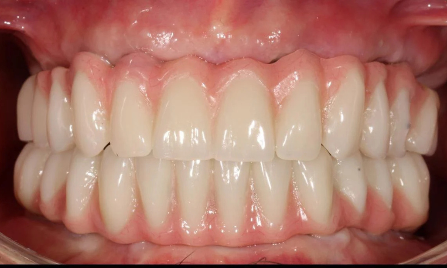 Bocca di un paziente dopo l'operazione con una nuova dentatura installata sull'impianto