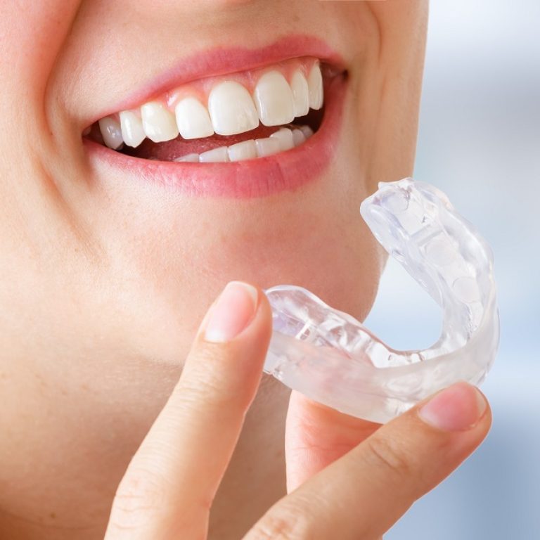 Woman wearing orthodontic silicone trainer. Invisible braces aligner. Mobile orthodontic appliance for dental correction.  Placing a bite plate in mouth to save teeth from grinding caused by bruxism.