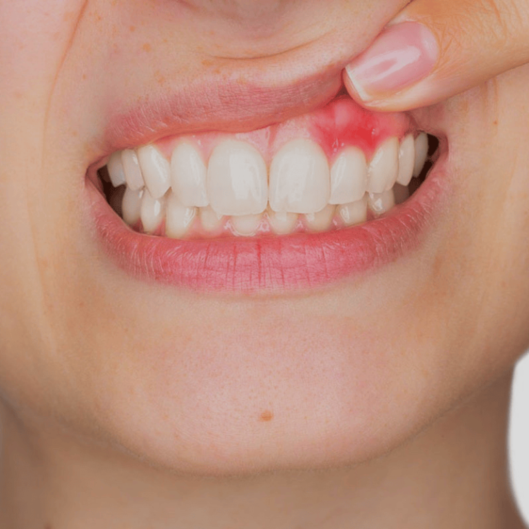 Immagine di un sorriso con denti con gengiva infiammata